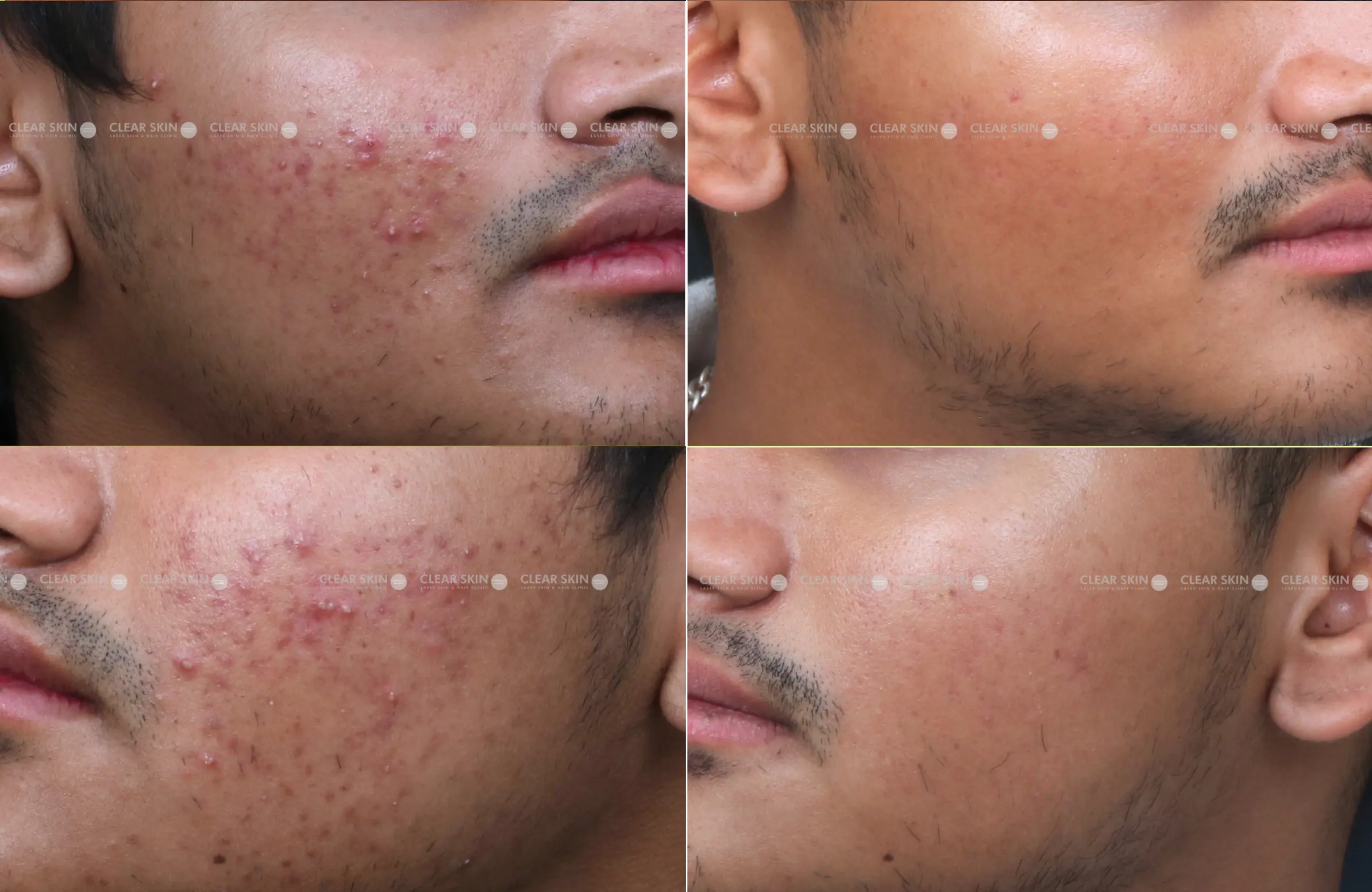 Acne After
