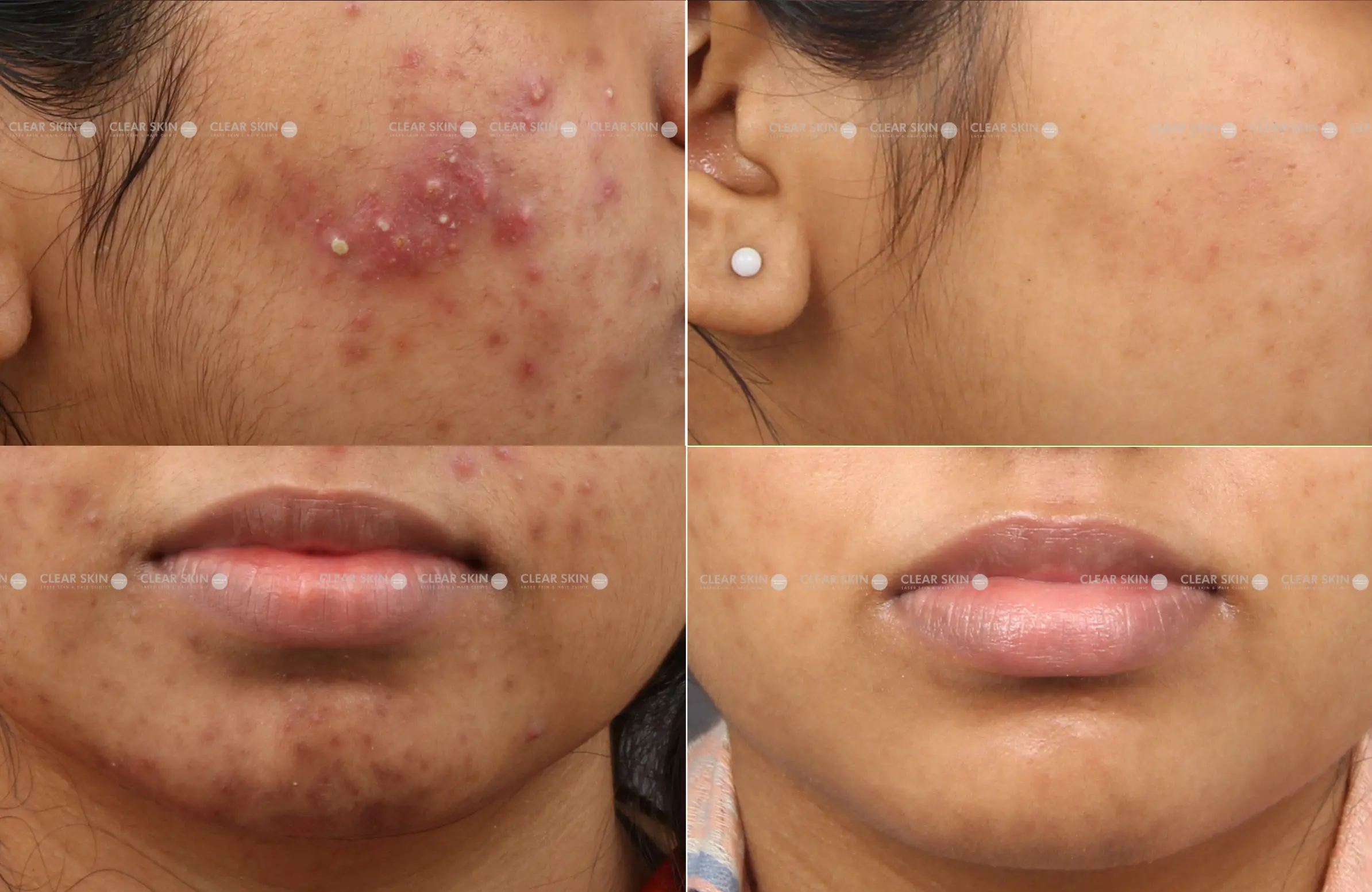 Acne Before