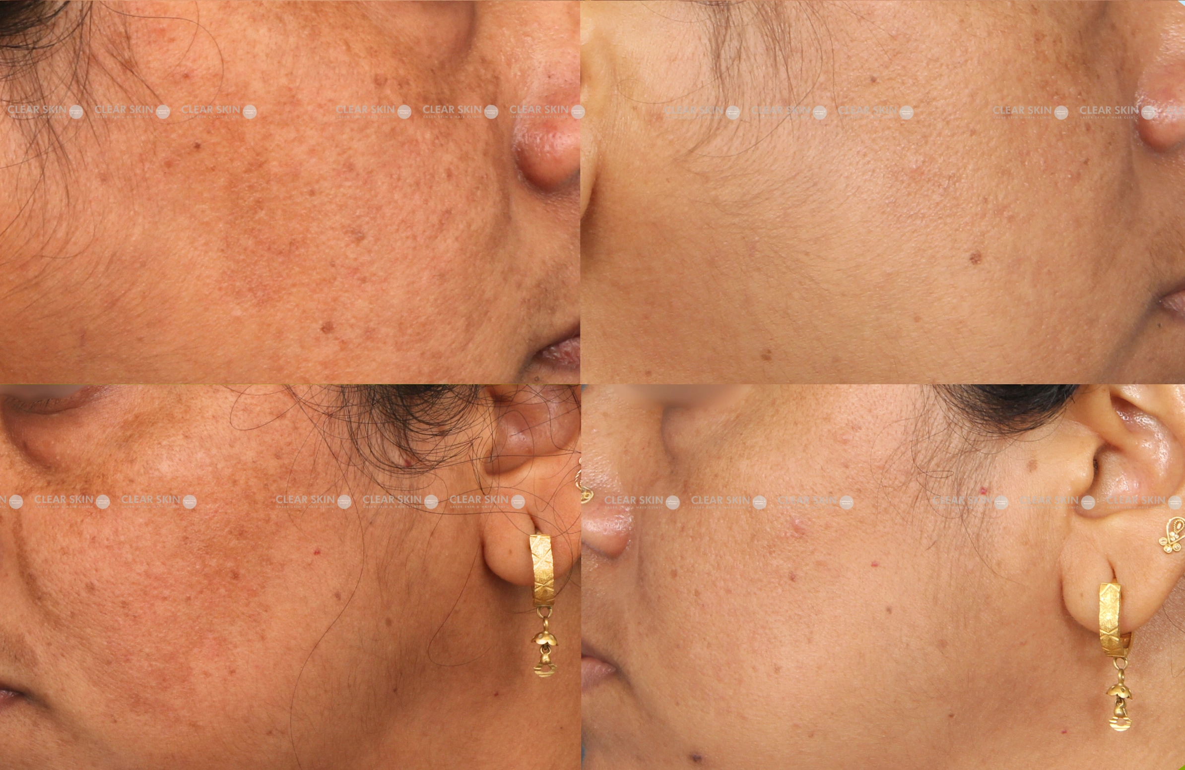 Melasma After