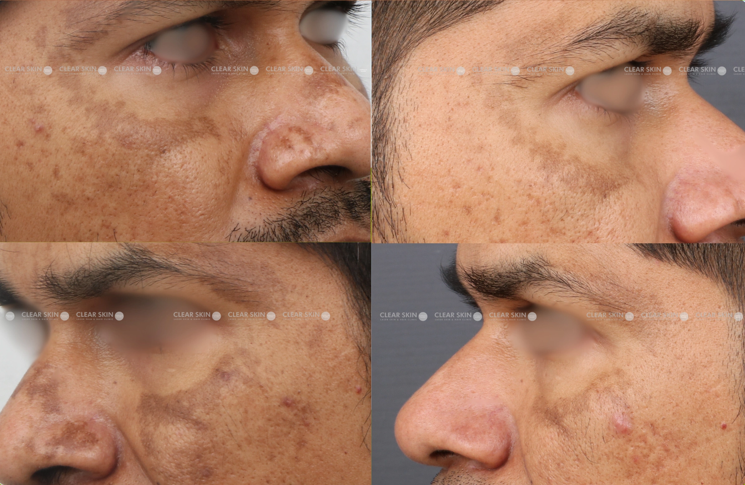 Melasma Before