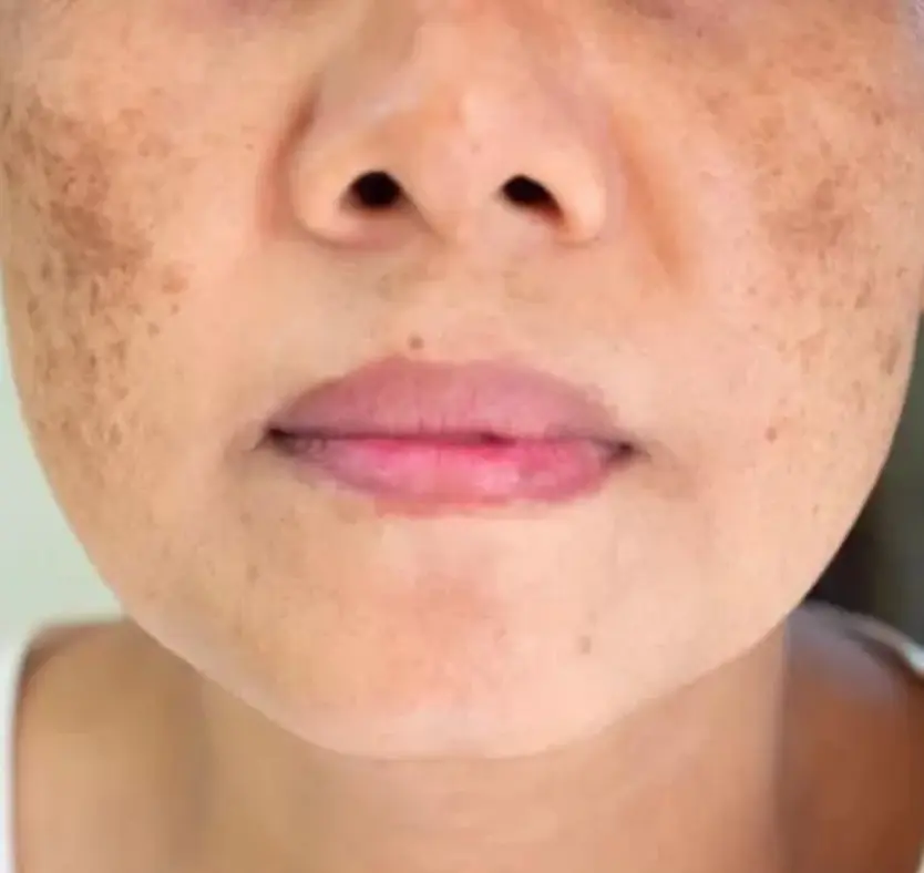 Melasma Treatment